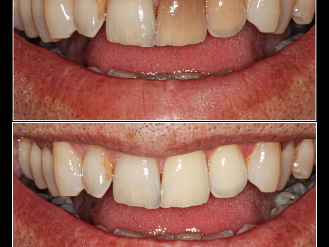 Internal Bleaching