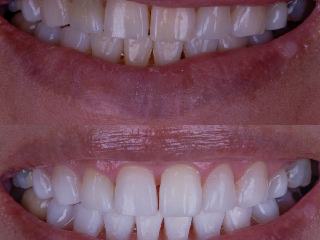Whitening