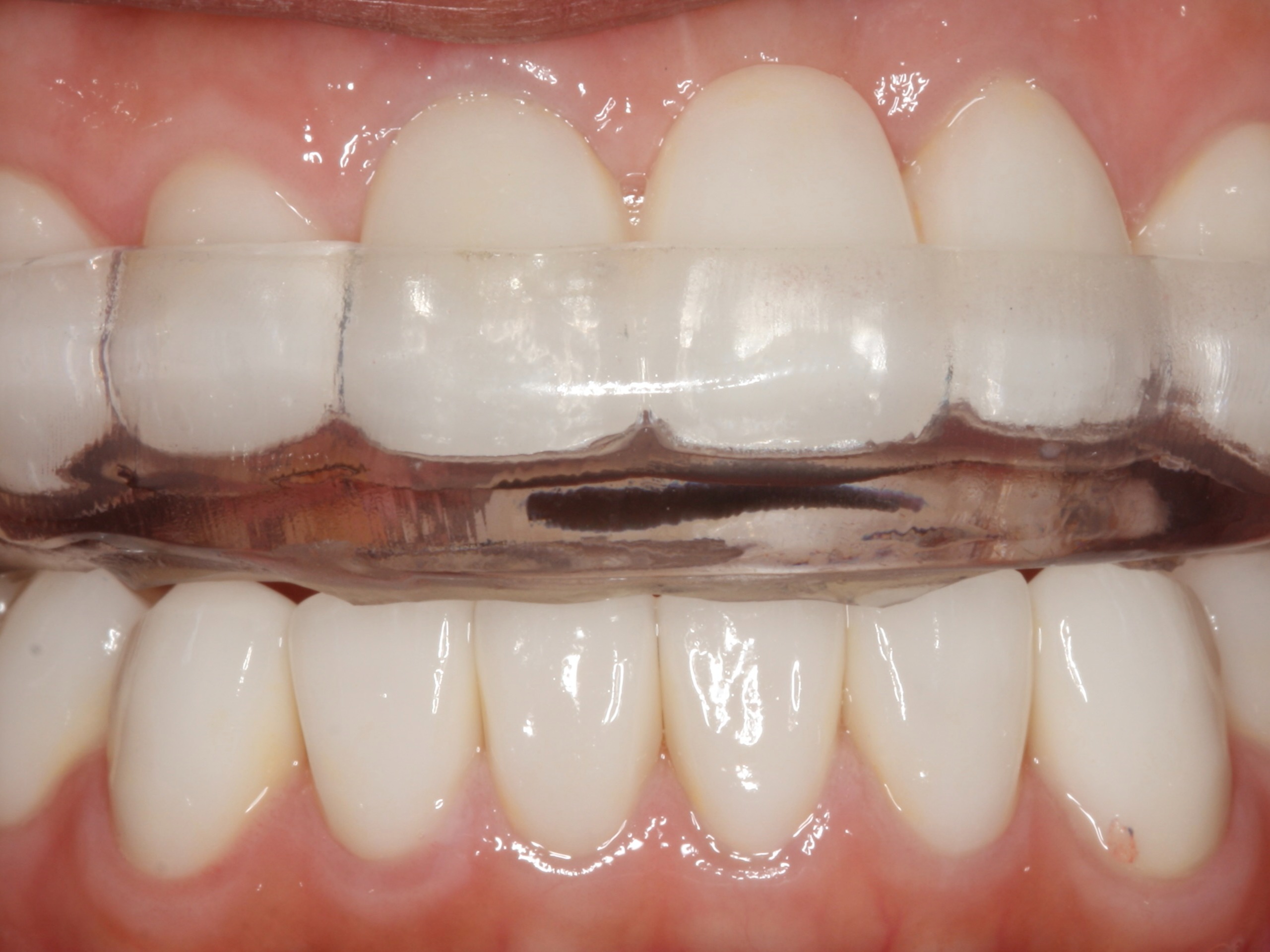 TMJ Treatment