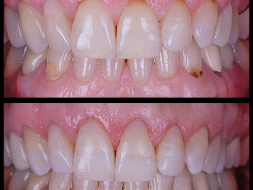 Tooth Colored Fillings