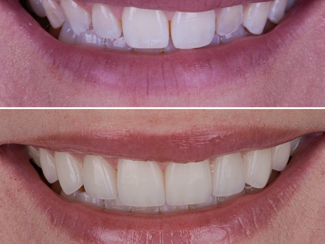 Veneers